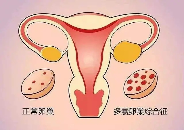 多囊卵巢综合症原因 多囊卵巢的症状表现